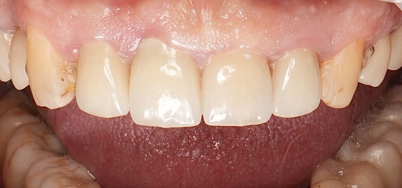 Priekinio danties šalinimas su momentinė implantacija, dantenų plastika ir laikinu vainikėliu. Implantuoja Jevgenij Travkin